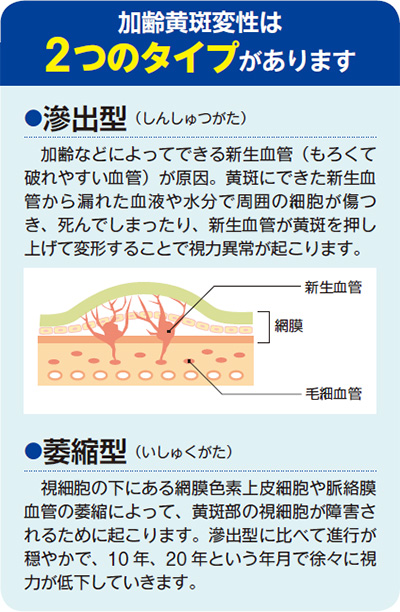 加齢黄斑変性は2つのタイプがあります。●滲出型(しんしゅつがた) 加齢などによってできる新生血管(もろくて破れやすい血管)が原因。黄斑にできた新生血管から漏れた血液や水分で周囲の細胞が傷つき、死んでしまったり、新生血管が黄斑を押し上げて変形することで視力異常が起こります。●萎縮型(いしゅくがた) 視細胞の下にある網膜色素上皮細胞や脈絡膜血管の萎縮によって、黄斑部の視細胞が障害されるために起こります。滲出型に比べて進行が穏やかで、10年、20年という年月で徐々に視力が低下していきます。