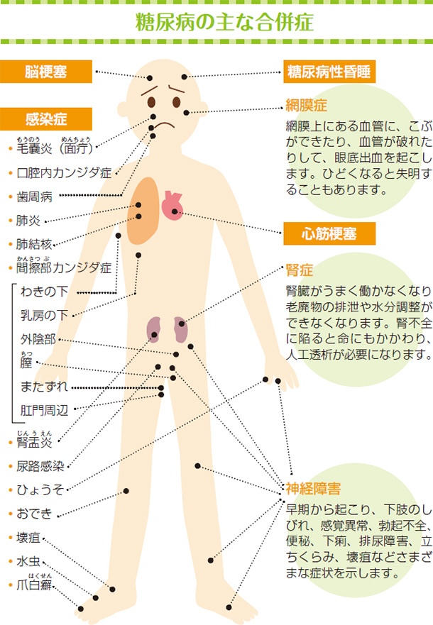 糖尿病の主な合併症