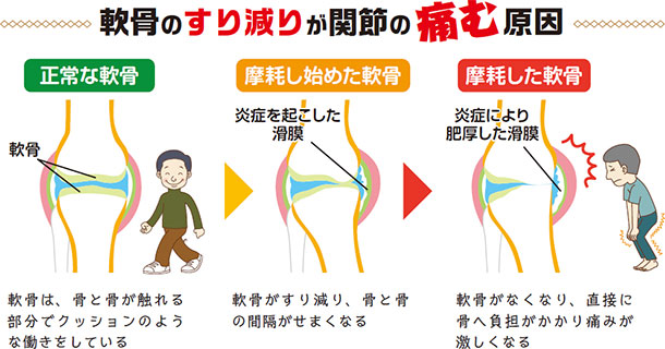 軟骨のすり減りが関節の痛む原因 軟骨は、骨と骨が触れる部分でクッションのような働きをしている 軟骨がすり減り、骨と骨の間隔がせまくなる 軟骨がなくなり、直接に骨へ負担がかかり痛みが激しくなる